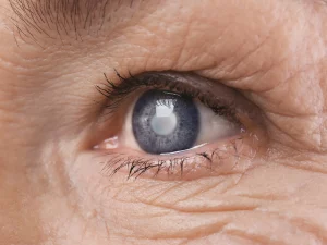 INOPTEC, Low Vision, Cataract, IOL Implant